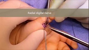 Congenital Trigger Thumb