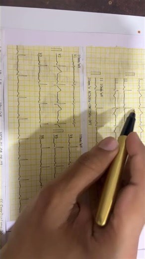 Classical finding , most common symptom ?