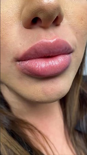 Obsessed with this lip filler ✨💉💕 #skincare #beauty #lipfillers