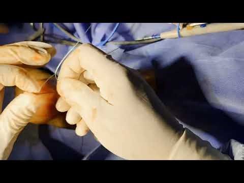 Achilles tendon repair for spontaneous rupture.