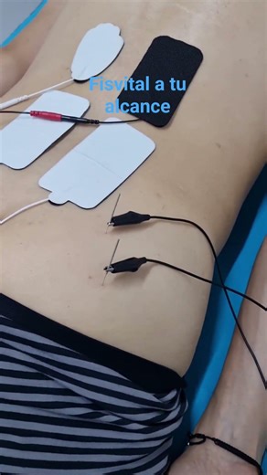 Síndrome del piramidal #salud