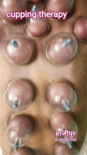 cupping therapy #therapistworldclubdoctor #foryou #motivation #therapy #doctor #youtubeshorts