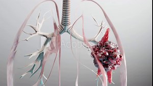 3d animation of human lungs Cancer , cancer growth , Tumor growing, 3D Rendered Medical Animation , Lungs Cancer Visualization , Pneumonia illness ,High quality 4k footage Stock Video