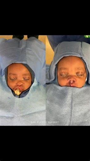 Dr. Huay-Zong Law on Instagram: "Do I need to repair a microform or incomplete cleft lip?⁠ ⁠ Not necessarily, but there are some pros and cons to doing surgery earlier.⁠ ⁠ Pros:⁠ - no memory of the surgery for the child⁠ - easier to control the environment, reducing the chances of a fall or accidental injury while healing⁠ - proven safety with decades of experience at this timing⁠ - preventing or reducing future problems like a deviated septum, and asymmetries of the lip and nose, so that any fu
