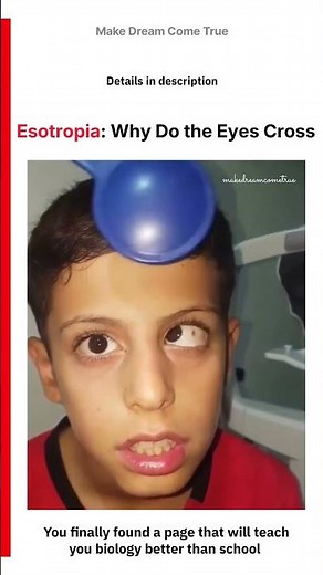 👁️ Esotropia: Why Do the Eyes Cross 🔍 | MDCT