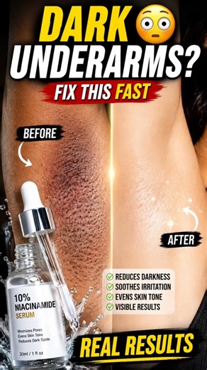 Dark Underarms? Here’s What Actually Helps 😳 #SkinCare #Dermatology
