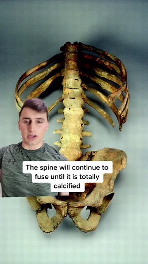 Understanding Bamboo Spine Condition with Mick Mars | Ankylosing Spondylitis Insights