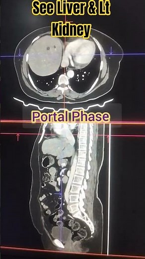 CT Triphasic Abd | CECT Triple Phase #medicos1k86 #radiology #doctor #liver #kidney #radiography #ct
