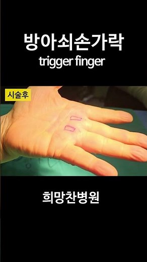 [#shorts ] 이렇게 손가락이 튕기는 이유는? #방아쇠손가락 #방아쇠수지 #triggerfinger #손가락통증