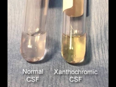 Xanthochromia yellowish discoloration of cerebrospinal fluid CSF; Causes, symptoms, Diagnosis, Treat