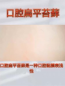 口腔扁平苔藓【视频四】