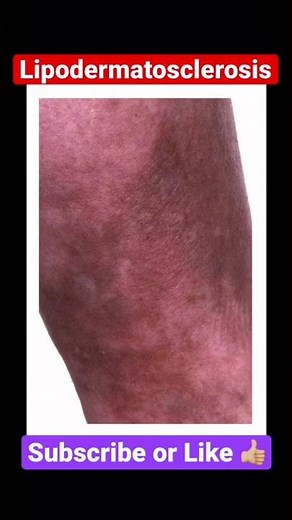 Lipodermatosclerosis