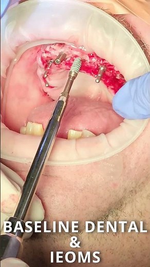 IMPLANT DENTURE PROCEDURE!! FIXED HYBRID ALL-ON-4 or X Procedure Before and After