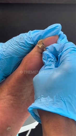 CORN / IPK REMOVAL! FULL VIDEO AVAILABLE NOW 🦶🏼 #medicalpedicure #satisfying #toenailcare