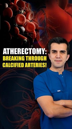 Atherectomy: Breaking Through Calcified Arteries