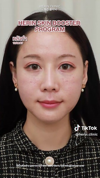 เซตผิวดาราที่ Herin Clinic เพื่อผิวฉ่ำวาว