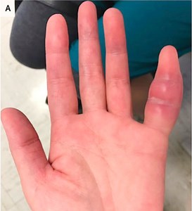 Woman's swollen pinky finger was rare sign of tuberculosis, UCSF doctors say