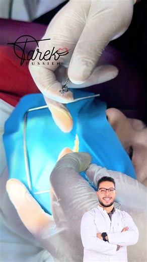 Saddle Matrix in Composite Restoration