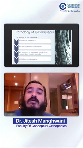 Why TB Causes Paraplegia? Pathology Simplified by Dr. Jitesh Manghwani