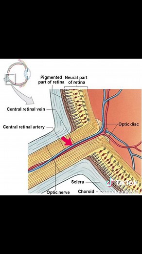 Understanding Papilledema: Causes and Treatment