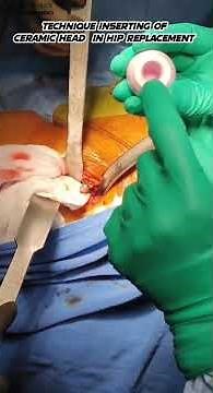Inserting Ceramic Head in Hip Replacement