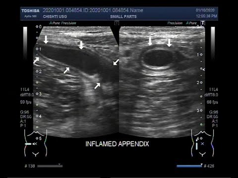 Ultrasound Video showing the technique to localize the Inflamed Appendix.