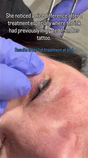 How to remove eyeliner tattoo with laser tattoo removal #shorts