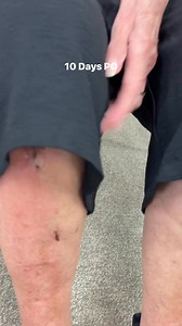 272K views · 817 reactions |  Day 10 After Total Knee Replacement –...