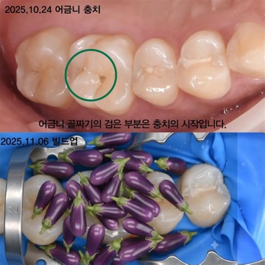 어금니 씹는 면 충치 레진 치료