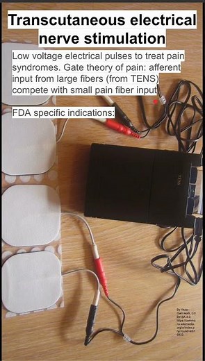 Transcutaneous electrical nerve stimulation