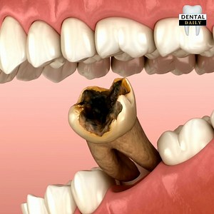 4.4M views · 46K reactions | Common dental procedures: updated video | Dental Daily | Facebook