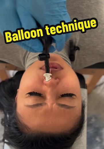 Nasal Balloon Technique for Effective Sinus Relief
