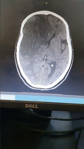 Massive Brain Edema On CT Scan #cerbraledema #drehtasham