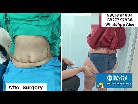 Liposuction Surgery In Delhi | Tummy Liposuction Surgery In Delhi | Before After Result