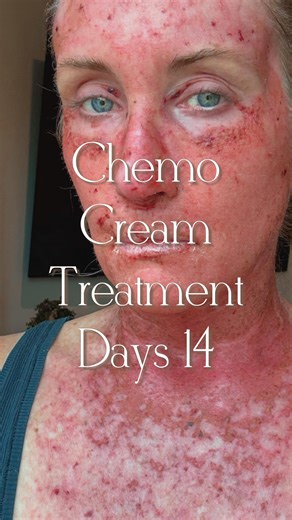 ☀️Kory Feltz☀️Burnt Freckle☀️ | Day 14 Frustration is at a whole new level now. I literally want to claw my skin off. Questioning why I am doing this and mustering up any... | Instagram