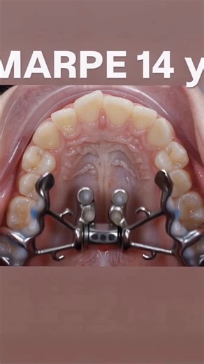 Dr. Svitlana Koval on Instagram: "Midfacial expansion within the MARPEFACE™️ protocol serves improvement in nasal passages volume, decrease in resistance at the level of the nasopharynx, serves as a runway for Mandibular expansion within its advancement. #marpeface™️ #drkovalorthodontics #airwayorthodontics #marpe #fme"