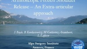 Arthroscopic Frozen Shoulder Release - An Extra-articular Approach