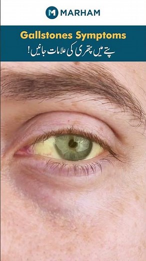 Gallstones Symptoms | Pitte mei Pathri ki Alamaat