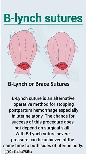 B-lynch suture or brace suture | #viralvideo #blynchsuture #suturere