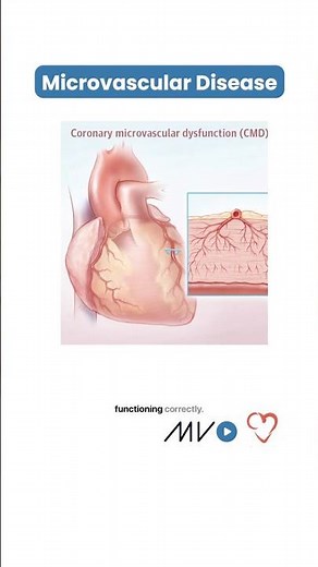 🚨 Microvascular disease: the hidden heart risk in women 🚨