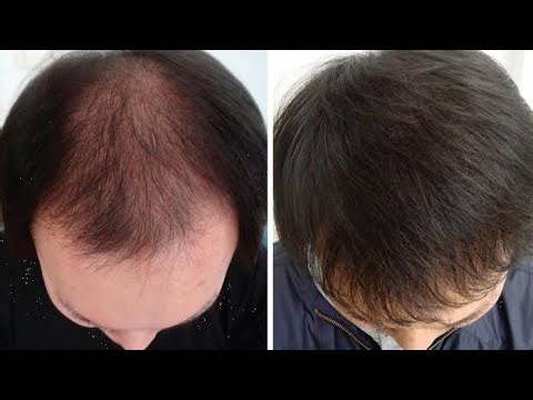 Finasteride Results After 6 Months: Before and After Comparison