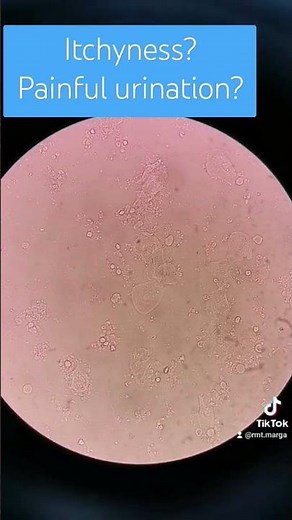 Trichomonas vaginalis under the microscope #laboratory #microscope #mls #cls #medtechstudent #urine