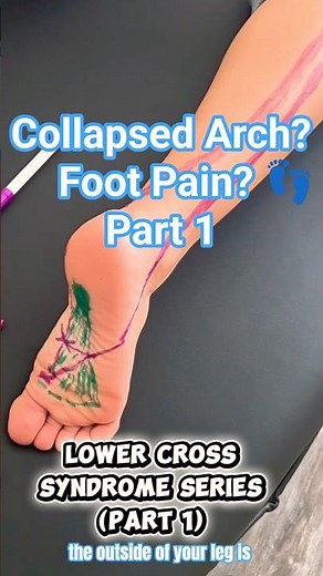 Foot Arch Pain Relief (Part 1) | Why Your Arch Collapses & How to Fix It! Lower Cross SyndromeSeries
