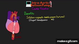 What is an Intra-Aortic Balloon Pump (IABP)? on Make a GIF