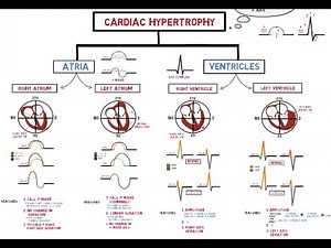 Electrocardiogram - Atrial & Ventricular Hypertrophy