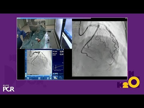 A mindset shift in the cathlab: leveraging technologies for PCI in complex patients - EuroPCR 2025