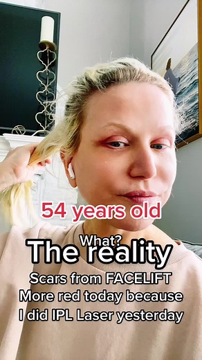 IPL Laser Treatment for Scar Removal After Facelift | Results Revealed