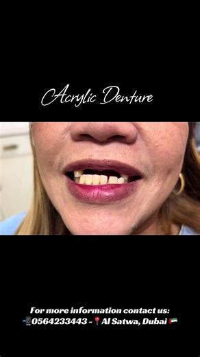 From missing teeth to a confident smile! ✨ This acrylic denture transformation gave our patient back their smile and confidence 🦷💫 Comfortable. Natural-looking. Life-changing. Book your consultation today! 📍 Al Satwa, Dubai 📞 056 423 3443 #HappyPatient #SmileTransformation #DenturesDubai #skinandsmiledentalclinic