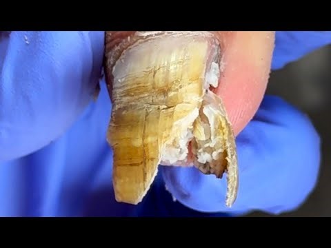 Extremely Long Toenails Have Large Patches Of Fungus, Cut Them Clean【Podiatry Clinic】