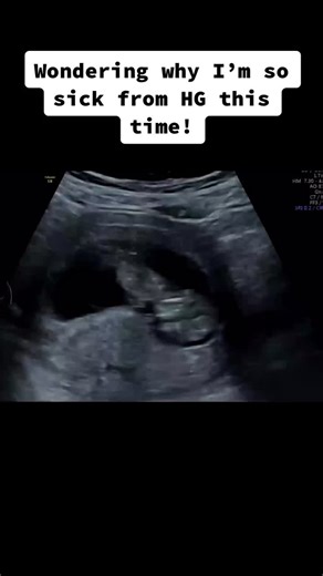 Ya’ll can keep your cute baby scan pics, I got these 🤦🏻‍♀️😂 #babyscan #pregnant #pregnantbelly #GoBoldColorista #foryou #fyp #motherhood